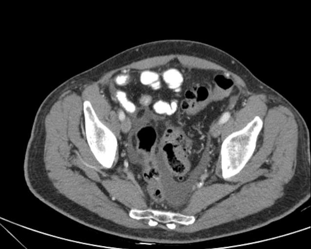 File:Cholecystitis - perforated gallbladder (Radiopaedia 57038-63916 A 71).jpg