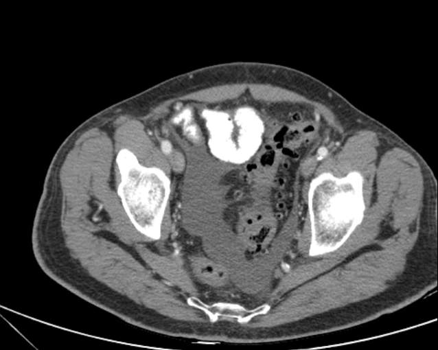 File:Cholecystitis - perforated gallbladder (Radiopaedia 57038-63916 A 73).jpg
