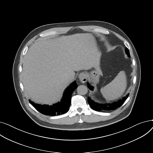 Cholecystitis with focal perforation and hepatic abscess (Radiopaedia 37189-38945 Axial non-contrast 14).png