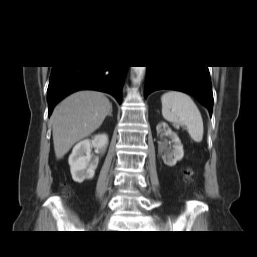 Cholecystoduodenal fistula (Radiopaedia 35234-36772 B 43).jpg