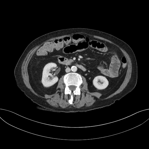 Cholecystoduodenal fistula due to calculous cholecystitis with gallstone migration (Radiopaedia 86875-103077 D 41).jpg
