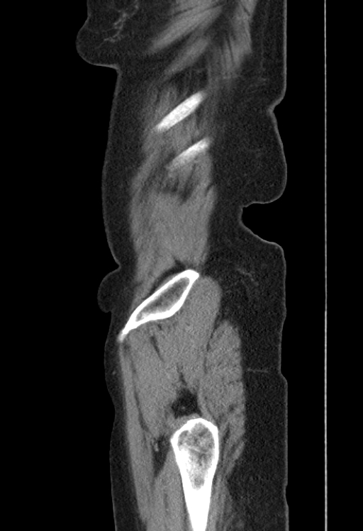 Cholecystoduodenal fistula due to calculous cholecystitis with gallstone migration (Radiopaedia 86875-103077 F 57).jpg