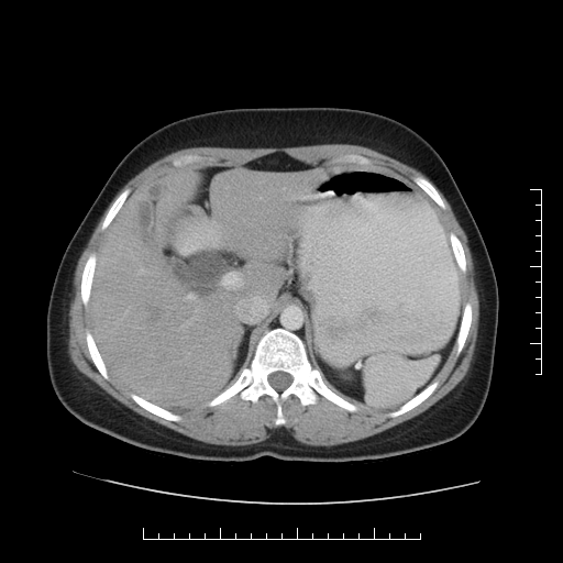 File:Choledochal cyst with chronic calcific pancreatitis (Radiopaedia 18245-18061 A 6).png