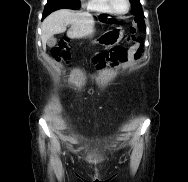 Choledocholithiasis on CT and MRI (Radiopaedia 24825-25087 C 13).jpg