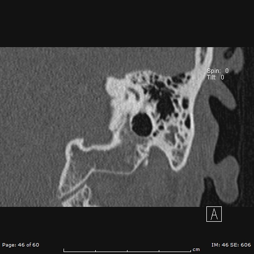 File:Cholesteatoma - external auditory canal (Radiopaedia 88452-105096 Coronal bone window 46).jpg