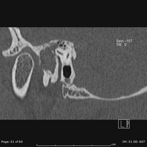 Cholesteatoma - external auditory canal (Radiopaedia 88452-105096 Sagittal bone window 31).jpg