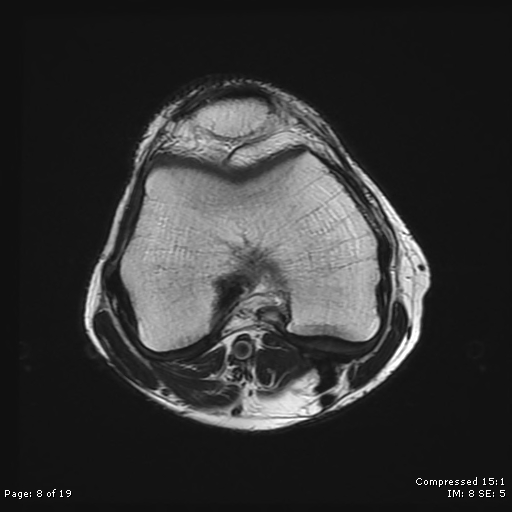 File:Chondroblastoma (Radiopaedia 25725-25891 Axial T2 8).jpg