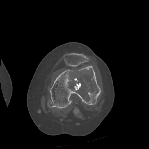 Chondrosarcoma - femur (Radiopaedia 64187-72954 Axial bone window 39).jpg