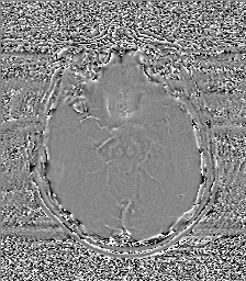 Chondrosarcoma - sphenoid wing (Radiopaedia 58259-67947 Axial SWI 32).jpg