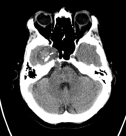 File:Chondrosarcoma of skull base- grade II (Radiopaedia 40948-43653 Axial non-contrast 8).png