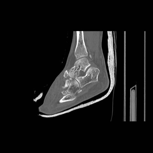 File:Chopart fracture (Radiopaedia 12386-12650 Sagittal bone window 7).jpg