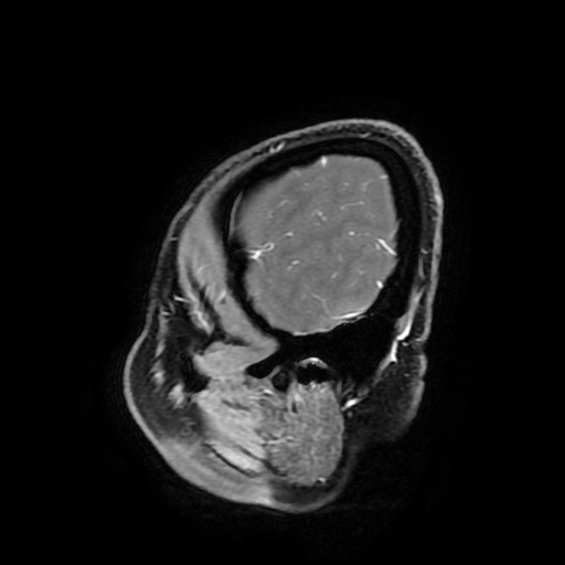 Chordoid glioma of third ventricle (Radiopaedia 91612-109340 F 182).jpg