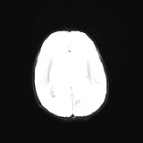 File:Choroid plexus papilloma (Radiopaedia 84612-100019 Axial DWI 16).jpg