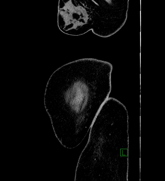 Chromophobe renal cell carcinoma (Radiopaedia 84239-99519 G 1).jpg