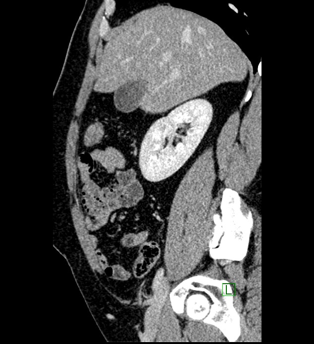 Chromophobe renal cell carcinoma (Radiopaedia 84286-99573 I 130).jpg