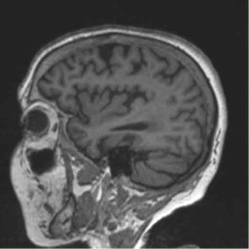 File:Chronic hypertensive encephalopathy (Radiopaedia 39993-42482 Sagittal T1 28).png