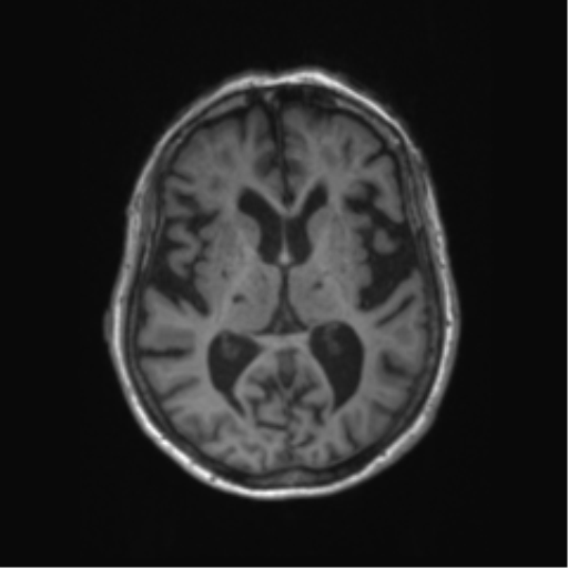 Chronic hypertensive encephalopathy (Radiopaedia 72844-83495 Axial T1 36).png
