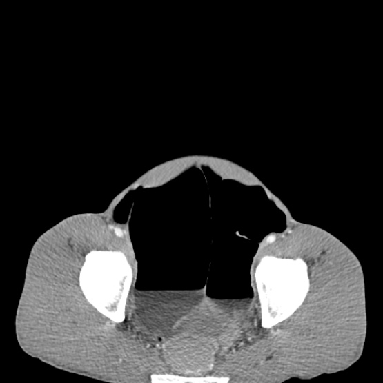 Chronic large bowel pseudo-obstruction (Radiopaedia 43181-46492 A 148).jpg