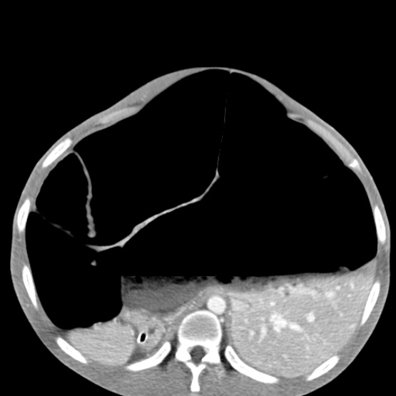 Chronic large bowel pseudo-obstruction (Radiopaedia 43181-46492 A 55).jpg