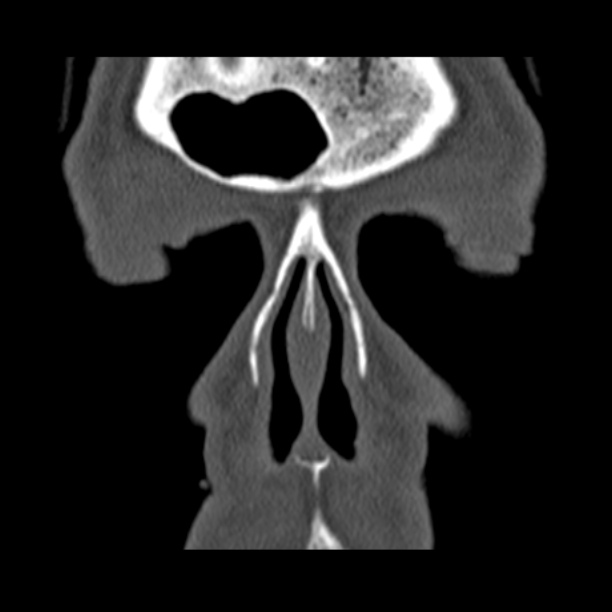 Chronic maxillary sinusitis (Radiopaedia 27879-28116 Coronal bone window 6).jpg