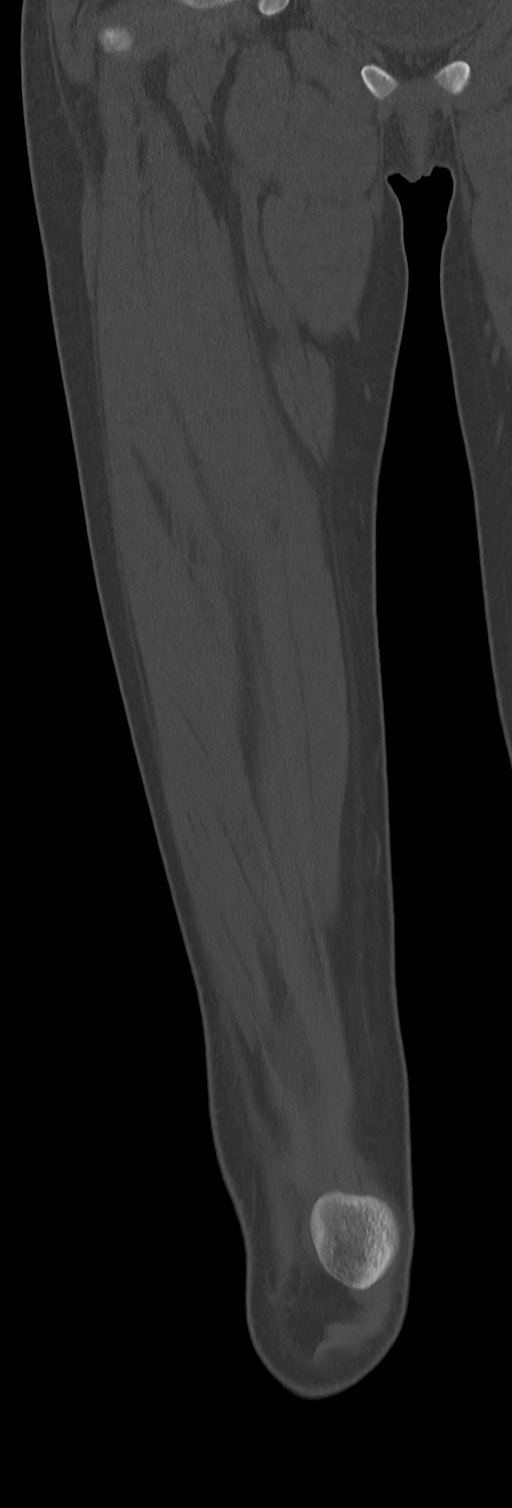 Chronic ostemyelitis of the femur with long sinus tract (Radiopaedia 74947-85982 Coronal bone window 27).jpg