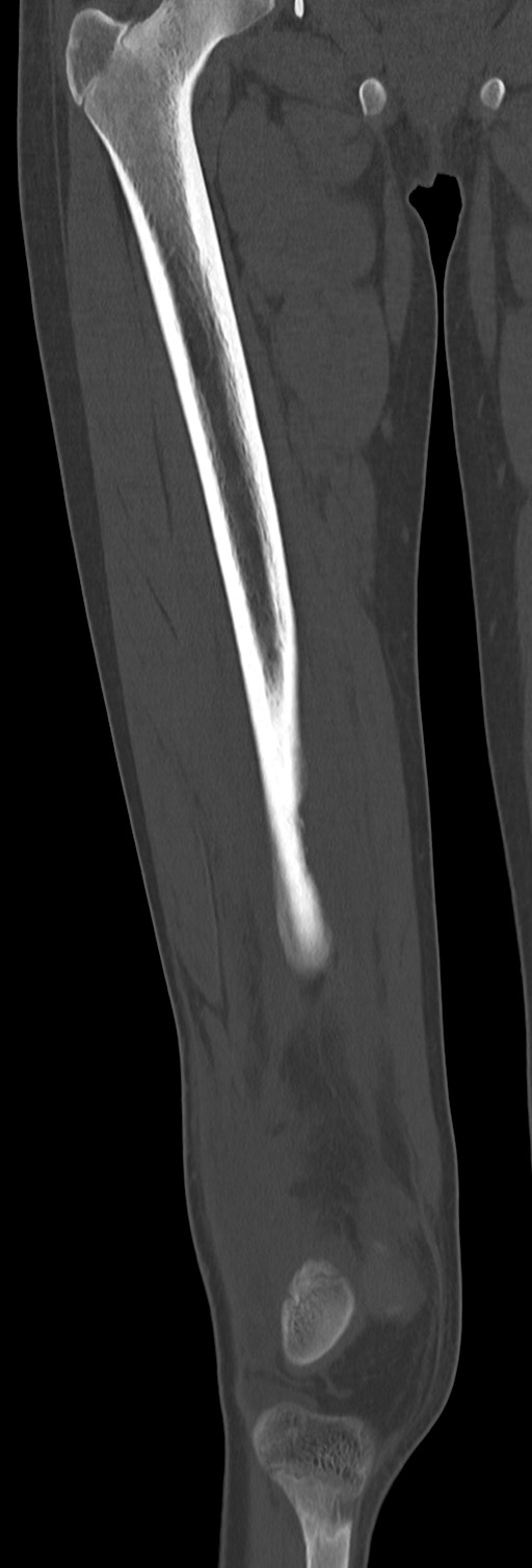 Chronic ostemyelitis of the femur with long sinus tract (Radiopaedia 74947-85982 Coronal bone window 35).jpg
