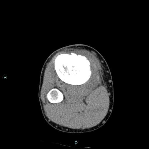 Chronic osteomyelitis (with Brodie abscess) (Radiopaedia 76405-88111 A 71).jpg