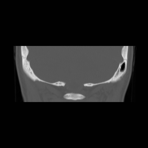 File:Chronic otomastoiditis (Radiopaedia 27138-27309 Coronal bone window 27).jpg