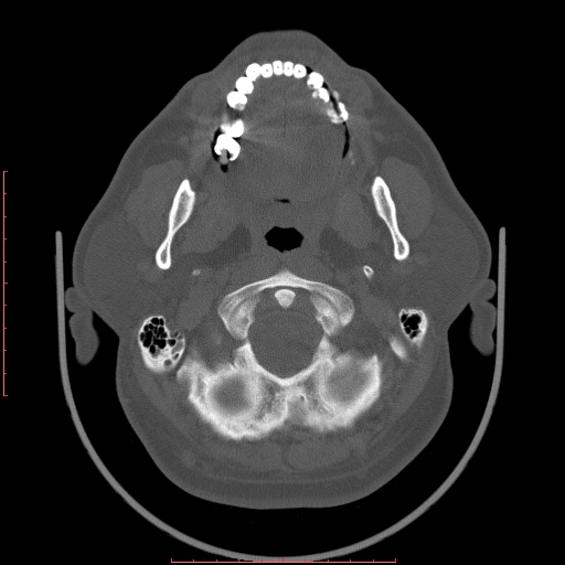 Chronic submandibular sialolithiasis (Radiopaedia 69817-79814 Axial bone window 20).jpg