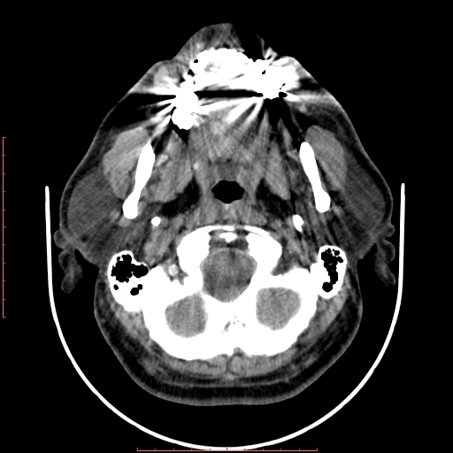 Chronic submandibular sialolithiasis (Radiopaedia 69817-79814 Axial non-contrast 48).jpg