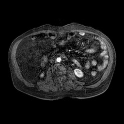 Cirrhosis and hepatocellular carcinoma in the setting of hemochromatosis (Radiopaedia 75394-86594 Axial T1 C+ fat sat 91).jpg