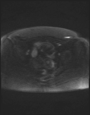 Class II Mullerian duct anomaly- unicornuate uterus with rudimentary horn and non-communicating cavity (Radiopaedia 39441-41755 Axial DWI 81).jpg