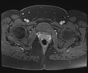 File:Class II Mullerian duct anomaly- unicornuate uterus with rudimentary horn and non-communicating cavity (Radiopaedia 39441-41755 Axial T1 fat sat 111).jpg