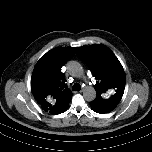 File:Classic complicated silicosis (Radiopaedia 49720-54961 Axial liver window 20).jpg
