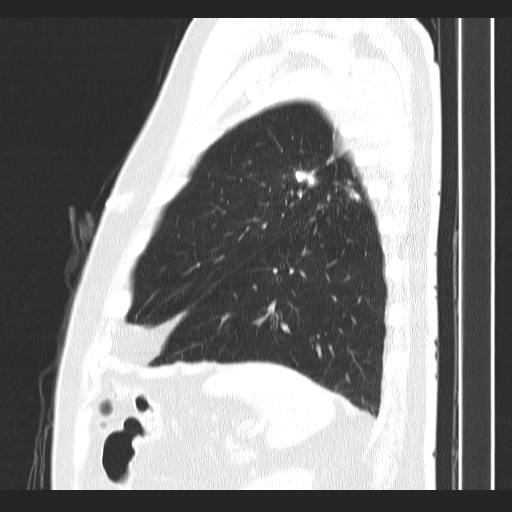File:Classic complicated silicosis (Radiopaedia 49720-54961 Sagittal lung window 12).jpg