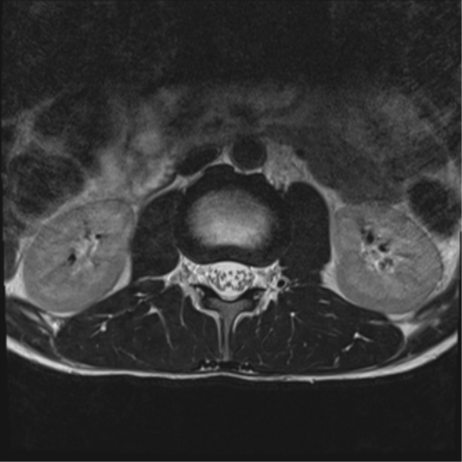 File:Clear cell meningoma - lumbar spine (Radiopaedia 60116-67690 Axial T2 34).png