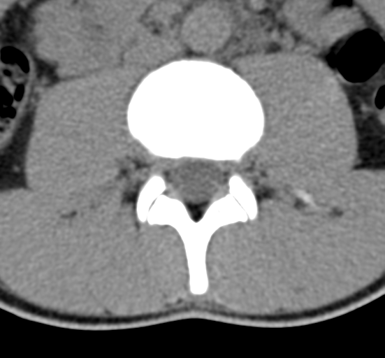 Clear cell meningoma - lumbar spine (Radiopaedia 60116-67691 Axial non-contrast 34).png