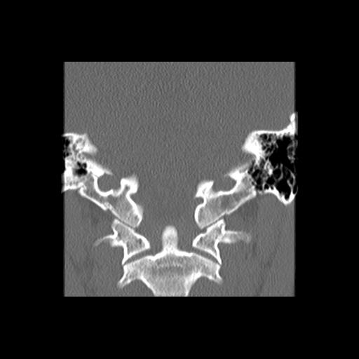File:Cleft hard palate and alveolus (Radiopaedia 63180-71710 Coronal bone window 42).jpg