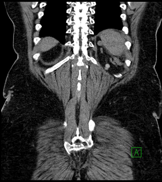 Closed-loop small bowel obstruction-internal hernia (Radiopaedia 78439-91096 Coronal non-contrast 86).jpg