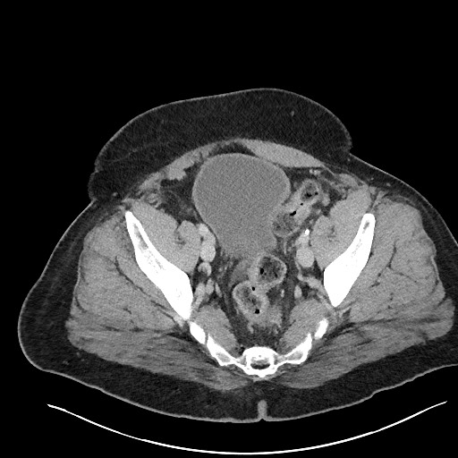 File:Closed loop obstruction - internal hernia into nephrectomy bed (Radiopaedia 59867-67320 Axial 100).jpg