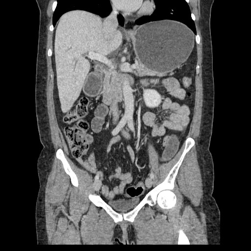 Closed loop small bowel obstruction (Radiopaedia 65403-74451 B 53).jpg