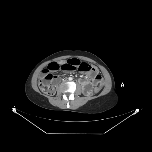 Closed loop small bowel obstruction (Radiopaedia 68471-78022 A 63).jpg