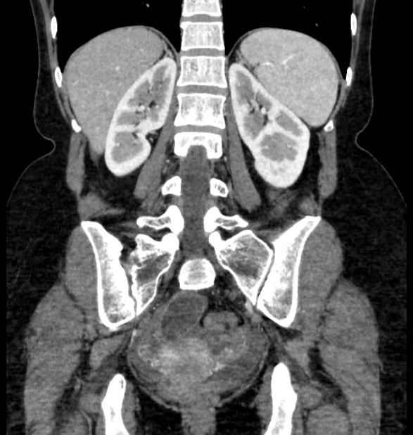 Closed loop small bowel obstruction (Radiopaedia 71211-81508 B 91).jpg