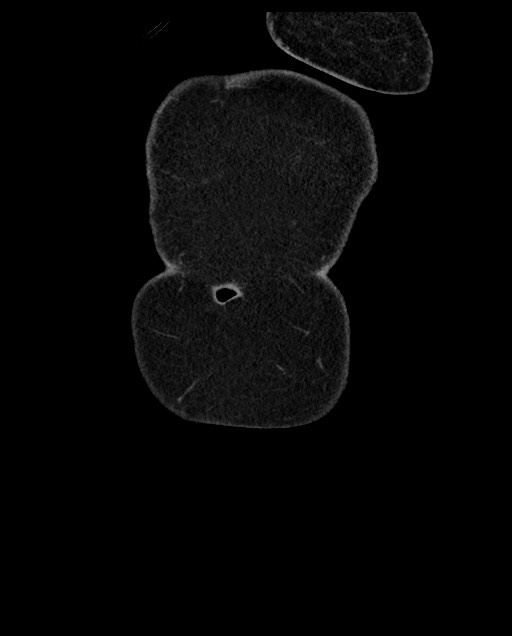 Closed loop small bowel obstruction - adhesions (Radiopaedia 59269-66611 B 6).jpg