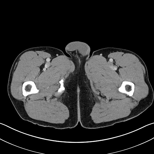 Closed loop small bowel obstruction - internal hernia (Radiopaedia 57806-64778 B 146).jpg
