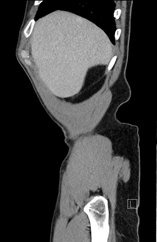 Closed loop small bowel obstruction - internal hernia (Radiopaedia 57806-64778 C 100).jpg