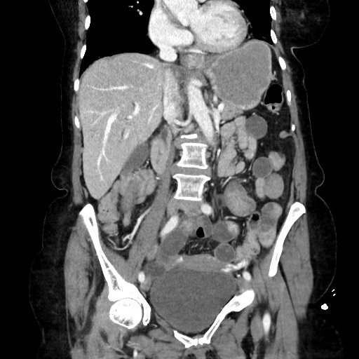 Closed loop small bowel obstruction due to adhesive band, with intramural hemorrhage and ischemia (Radiopaedia 83831-99017 C 61).jpg
