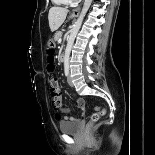 Closed loop small bowel obstruction due to adhesive bands - early and late images (Radiopaedia 83830-99014 C 97).jpg