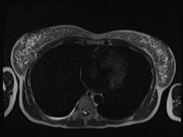 File:Closed loop small bowel obstruction in pregnancy (MRI) (Radiopaedia 87637-104031 Axial T2 1).jpg