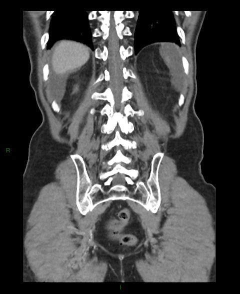 File:Closed loop small bowel obstruction with ischemia (Radiopaedia 84180-99456 B 11).jpg